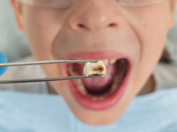 Best Emergency Wisdom Teeth Removal in Atkinson, NE
